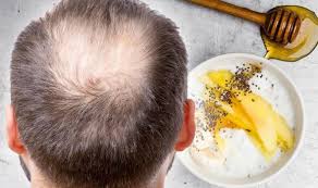 It's characterized by gradual thinning of your hair, which may be noticeable as a widening part or a ponytail that's less hefty than it used to be. Hair Loss Treatment Prevent Alopecia Symptoms And Boost Hair Growth In Greek Yoghurt Diet Express Co Uk