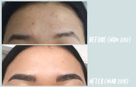 The first month is free. Curology Review It Actually Cured Our Acne Problem Song Of Style