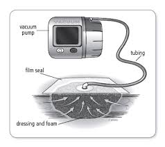 Negative Pressure Wound Therapy Wound Care