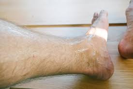 Hyperhidrose Plantaris Schweissfusse Feetastic