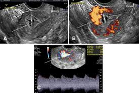 Ultrasound scans are used to evaluate fetal development, and they can detect problems in the liver, heart, kidney, or abdomen. Ultrasound Diagnosis And Management Of Acquired Uterine Enhanced Myometrial Vascularity Arteriovenous Malformations American Journal Of Obstetrics Gynecology