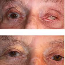 Elle a des yeux pleins de feu. Prothese Oculaire Epithese Faciale A Montpellier Herault 34
