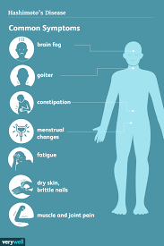 Hashimoto S Disease Signs Symptoms And Complications Hashimotos Disease Hashimotos Disease Symptoms Thyroid Disease Symptoms