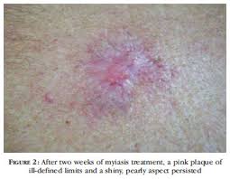 There are several ways for flies to transmit their larvae to people. Scielo Brasil Concurrent Primary And Secondary Myiasis On Basal Cell Carcinoma Concurrent Primary And Secondary Myiasis On Basal Cell Carcinoma