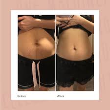 Stretcheal is a powerful stretch mark treatment cream and scars defense cream to make the appearance of red, white and purplish marks disappear. Stretch Mark Removal Treatment At Cambridge Therapeutics Cambridge Therapeutics