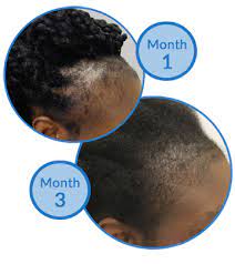 The main reason that hair loss is reversible is that male pattern baldness is not natural. Reversible Forms Of Female Hair Loss
