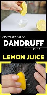 How To Get Rid Of Dandruff With Lemon Juice Getting Rid Of Dandruff Dandruff Remedy Home Remedies For Dandruff