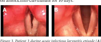 Image result for Acute Laryngitis
