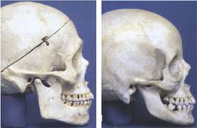Shoulders still too big on this. Facial Feminization Surgery Brow Bone Reduction Transforming A Prominent Male Forehead Into A Feminine One 2pass Clinic
