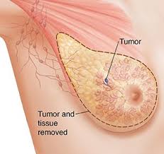 Image result for Mastectomy