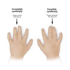 Image result for Syndactyly