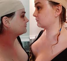 I'd post a pic for you guys but you can't see it in a picture 😔 BUT I'm  still stoked and wanna share! 😁 4th injection was yesterday and I woke up