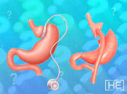 Magenband Und Magenbypass Welches Ist Besser Dr He Obesity Clinic