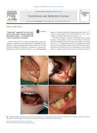Image result for Alveolitis sicca)
