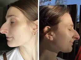 People Can't Believe How This Woman Looks After Getting A $11k Nose Job