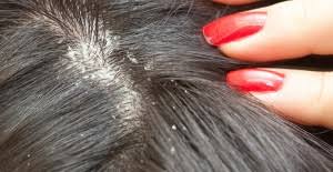 Other types of lice include body lice and pubic lice. Identify Head Lice Photos And Examples Head Lice Specialist