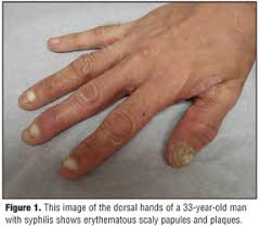 Image result for Neurosyphilis