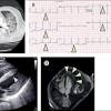 What are the symptoms of myocarditis? 1