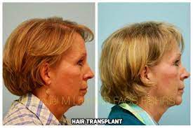 This 58 Year Old Woman Is Shown Before And One Year After Hair Transplant To Restore Lost Hair Density Hair Transplant Women Lost Hair Hair Transplant