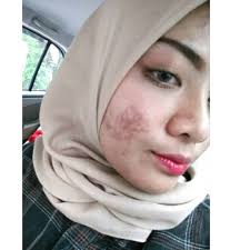 8,073 sukaan · 91 berbicara tentang ini · 22 pernah berada di sini. Inilah Gambar Muka Saya Semasa Breakout Tapi Dah Pulih Selepas Jalani Rawatan Rm300 The Reporter