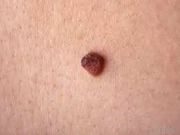 Discovering new growths on your skin can cause your mind to race towards worrying about cancer, but take heart. How Can I Tell The Difference Between A Mole And Skin Cancer