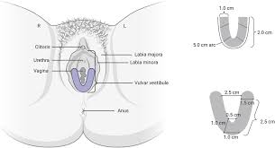 Image result for Localized Vulvar Dysesthesia