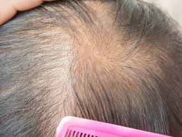 Grey i'm definitely going to dye my hair. Thinning Hair Causes Types Treatment And Remedies