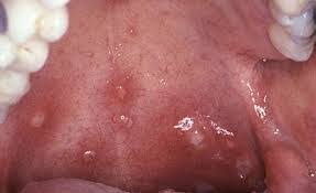 Maybe you would like to learn more about one of these? What Causes Bumps In Back Of Throat New Health Advisor