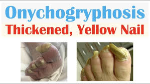 Image result for Yellow nail syndrome feet