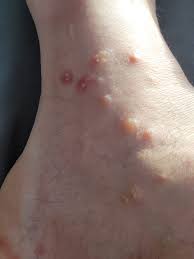 Image result for ant bite