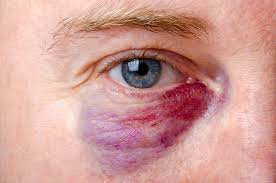 This can also lead to a reduction in eye movement and double vision. You Woke Up With Swollen Eyes Or Eyelids Don T Panic Silverstein Eye Centers