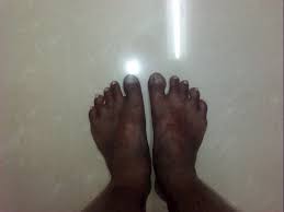 Image result for toe black diabetes
