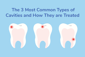 What do i do if i have an interproximal cavity? The 3 Types Of Cavities How To Treat And Prevent Them Gentle Dental