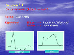 Andin tetap ngotot untuk memberitahu soal roy pada elsa. Ekg Normal Ima Aritmia Yang Mengancam Nyawa Ppt Download