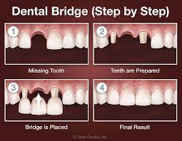 Check spelling or type a new query. Dental Bridge Dentist Lady S Island Beaufort Sc