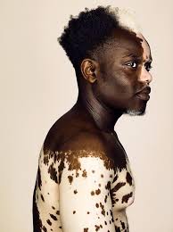 Black And White Skin Condition Model Finding Beauty In Difference Model Bashir Aziz Opens Up About Living With Vitiligo About Bashir Beauty Difference Finding Vitiligo Model Human Vitiligo