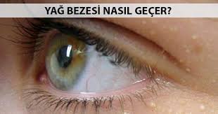 Yag Bezesi Tedavisi Nasil Olur Yag Bezesi Nasil Gecer
