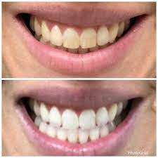 19 Teeth Whiteners That Work So Well It S Basically Magic