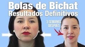 La información sobre precios del tratamiento bichectomía, es diferente de acuerdo a las condiciones específicas del paciente. Bolas De Bichat 10 Verdades Mitos Y Mentiras Clinicas Diego De Leon