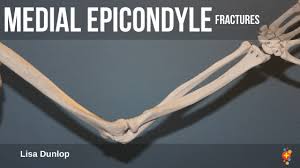 Kilfoyle classified these fractures into three types according to the degree of displacement 5. Medial Epicondylar Fractures Of The Humerus