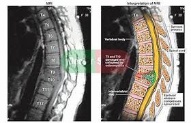 Image result for Spinal Infection