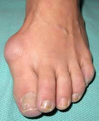 Come see our new york city bunion treatment center and meet dr. Case Study Severe Bunion Surgery Opening Base Wedge Osteotomy Best Podiatrist Nyc Lawrence Silverberg Dpm 20 E 46th St New York Ny 10017 The Best Bunion Surgery Hammertoe Surgery In Nyc