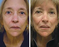 Lip Augmentation With Porcine Small Intestinal Submucosa