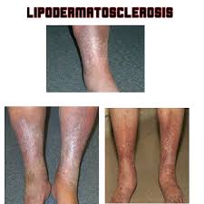 Image result for Lipodermatosclerosis