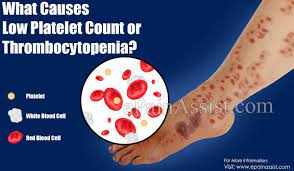 Causes Of Low Platelet Count Or Thrombocytopenia, Its Effects & Ways To  Increase Platelet Count Naturally
