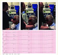 Ecg Rhythm Strip During Carotid Sinus Massage Leading To Asystole And Download Scientific Diagram