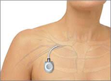 Some chemo or immunotherapy is taken for a much shorter duration, and some are not as toxic to the body. To Port Or Not To Port Advantages Disadvantages Green Bay Oncology