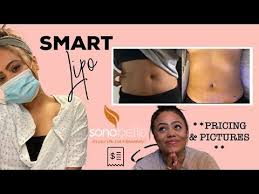 I Got Laser Lipo With Sono Bello Before After Pics Part One Youtube In 2020 Laser Lipo Lipo Bello
