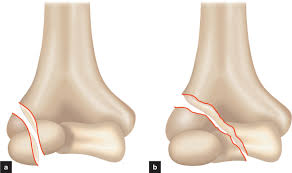 Image result for Lateral Condyle Fracture