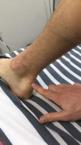 13,415 likes · 48 talking about this. What Is A Tendinopathy Physiotherapy In Burnie Somerset Coastal Physiotherapy